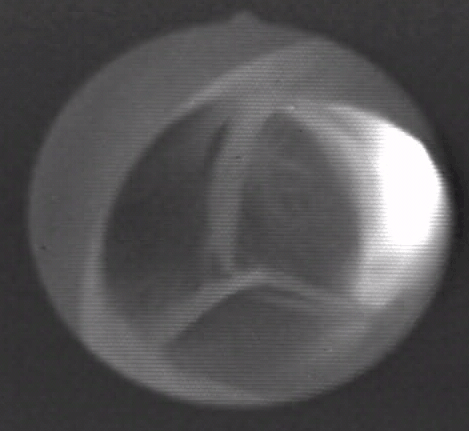 File:Aortic valve (1).gif