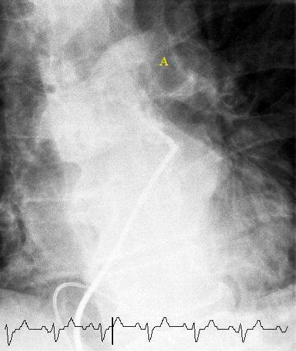 File:Pulmonary embolism selective angiogram.JPEG