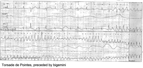 Torsade de Pointes.png
