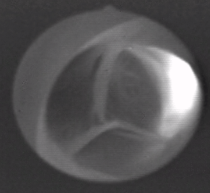 Aortic valve (1).gif