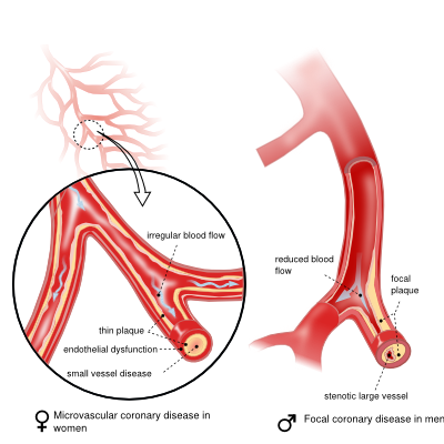 Differences in coronary artery disease by gender.svg