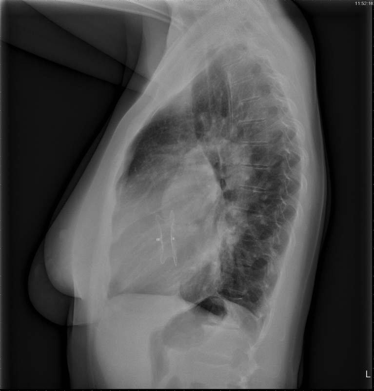 Figure 23. Chest radiograph, left lateral view, of a 34-year old female who recently underwent percutaneous closure of her ASD with an Amplatzer device.