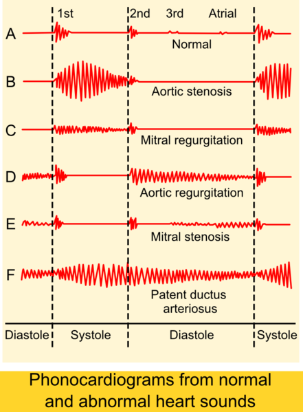 File:441px-Phonocardiograms from normal and abnormal heart sounds.png