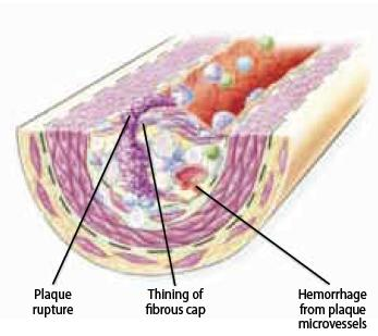 File:Figure 10 - The ruptured plaque..png