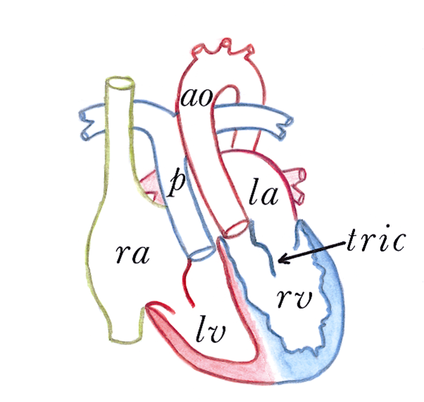 File:Figure 14. Congenitally corrected transposition of the great arteries.png