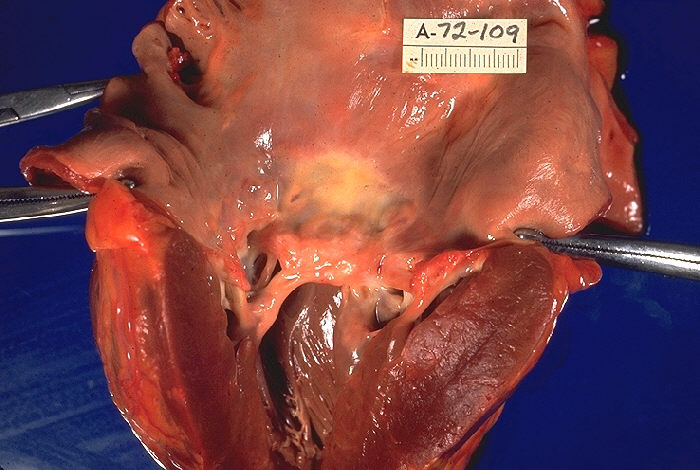 File:Rheumatic heart disease, gross pathology 20G0013 lores.jpg