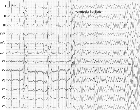 ECG recording of idiopathic ventricular fibrillation (IVF) in a risk haplotype carrier. The short coupled ventricular extrasystoles from the right ventricular apex/lower free wall (indicated by asterisks) first result in compensatory pauses and then in IVF requiring external defibrillation