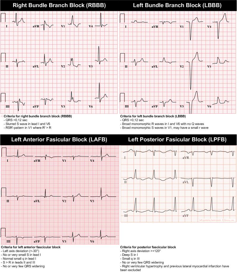 Intraventricular Conduction.jpg