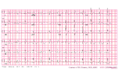 Brugada syndrome type1 example5.png