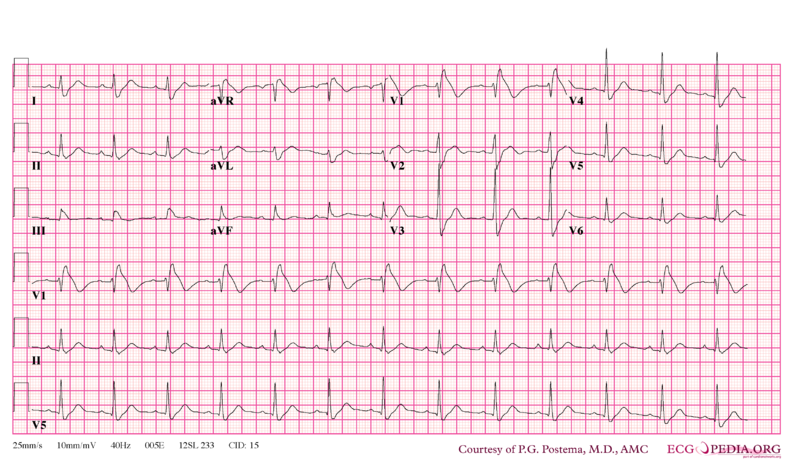File:Brugada syndrome type1 example5.png