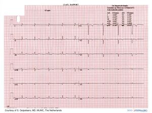 ECG SitusInversus ElektrodesPlacedLeft.JPG