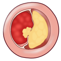 Plaque rupture clot.svg