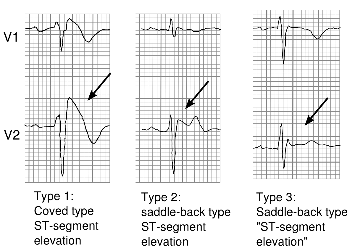 Экг при синдроме бругада. Acute pain and sharp pain. Серьги виды замков и названия. Производные от pain. Relaxed posture.