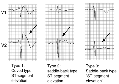 PlaatjesBrS graphs.svg