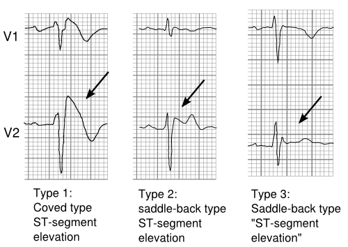 PlaatjesBrS graphs.svg