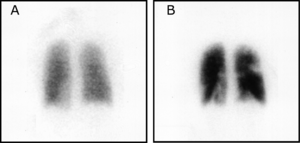 Pulmonary embolism scintigraphy PLoS.png