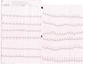 Pulmonary embolism ECG.jpg