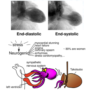 Image9 Takotsubo.svg