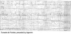 Torsade de Pointes.png