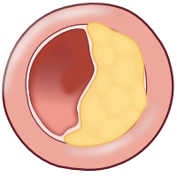 Plaque rupture B.svg