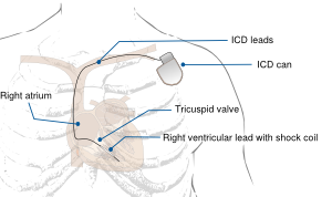 ICD device.svg