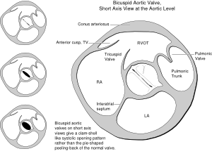 Heart bicuspid aortic valve.svg