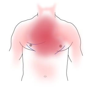 kórtörténet hipertónia angina pectoris)