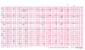 Brugada syndrome type1 example4.png