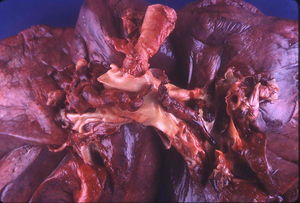 Saddle thromboembolus.jpg