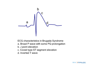 Brugada ecg characteristics.png