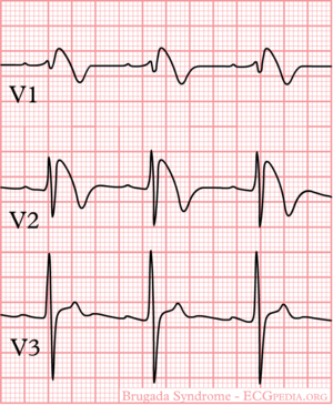 Brugada Syndrome Textbook Of Cardiology