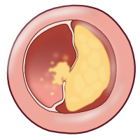 Plaque rupture C.svg