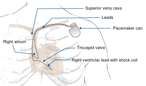 Pacemaker device.svg