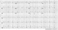 A 12 lead ECG of a patient with genetically proven LQTS3