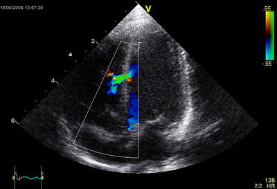 Ventricular Septal Defect.jpg