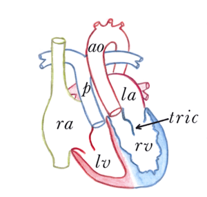 Figure 14. Congenitally corrected transposition of the great arteries.png