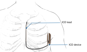 Subcutaneous ICD.svg