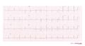 Brugada syndrome type2 example2.jpg