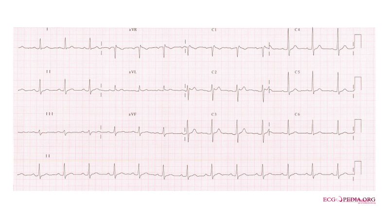File:Brugada syndrome type2 example2.jpg