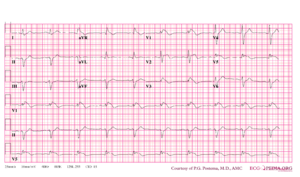 Brugada syndrome type1 example2.png