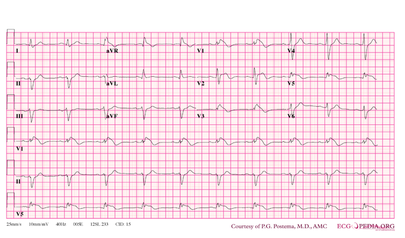 File:Brugada syndrome type1 example2.png