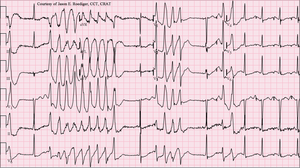 Torsades de Pointes.png