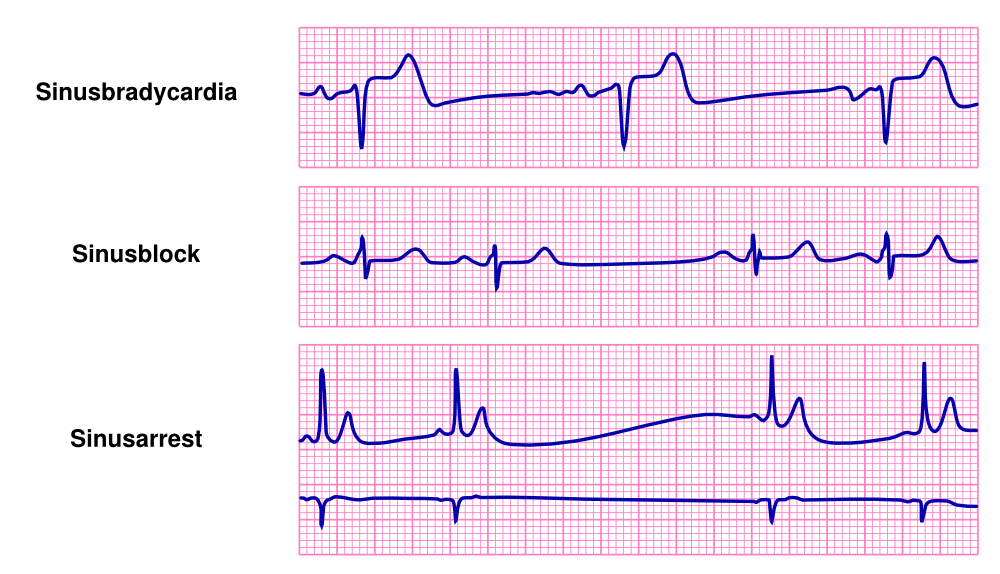 Bradycardia textbook of cardiology