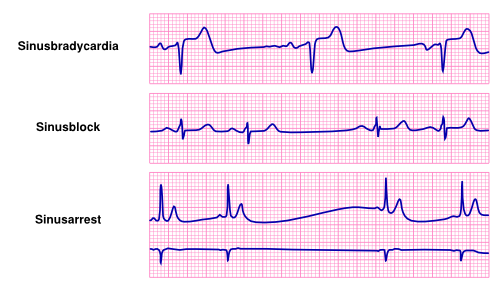 Bradycardia Textbook Of Cardiology