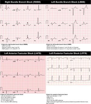 Intraventricular Conduction.jpg