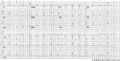 A 12 lead ECG of a patient with genetically proven LQTS2