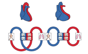 Figure 13. Schematic drawing of the circulation in transposition of the great arteries.png