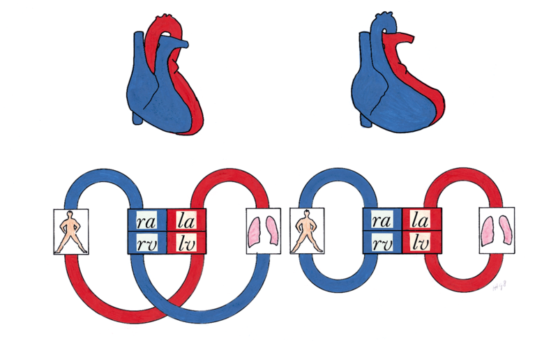 File:Figure 13. Schematic drawing of the circulation in transposition of the great arteries.png