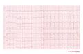 Brugada ECG during ajmaline testing