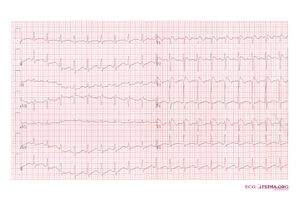 Brugada syndrome type1 example6.jpg